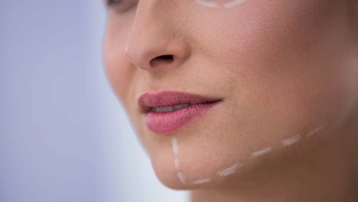 JAW FILLERS